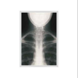 Infant Chest X rayPrint (Canvas 12x18)